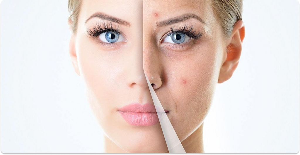 Peeling Químico